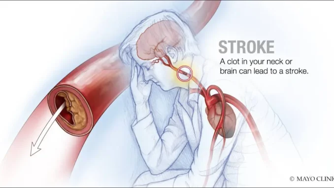 stroke2-1200x628